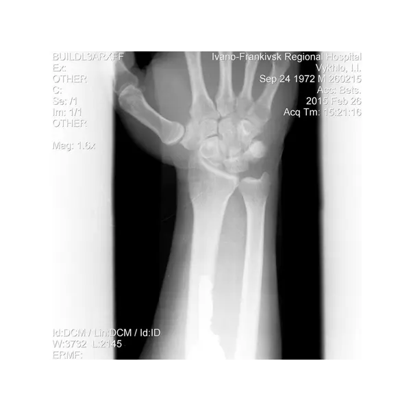 Універсальна іммобілізаційна шина BM Splint M-10
