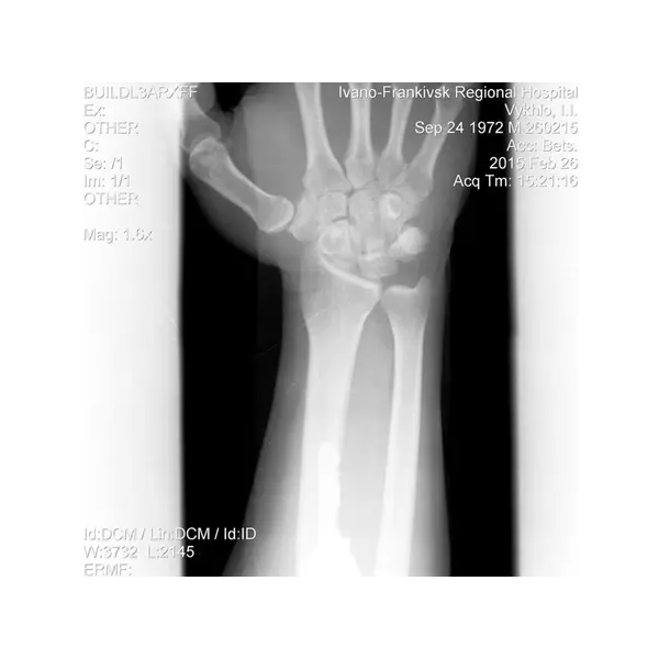 Універсальна іммобілізаційна шина BM Splint M-5 для ліктьового суглоба (47×11 см)
